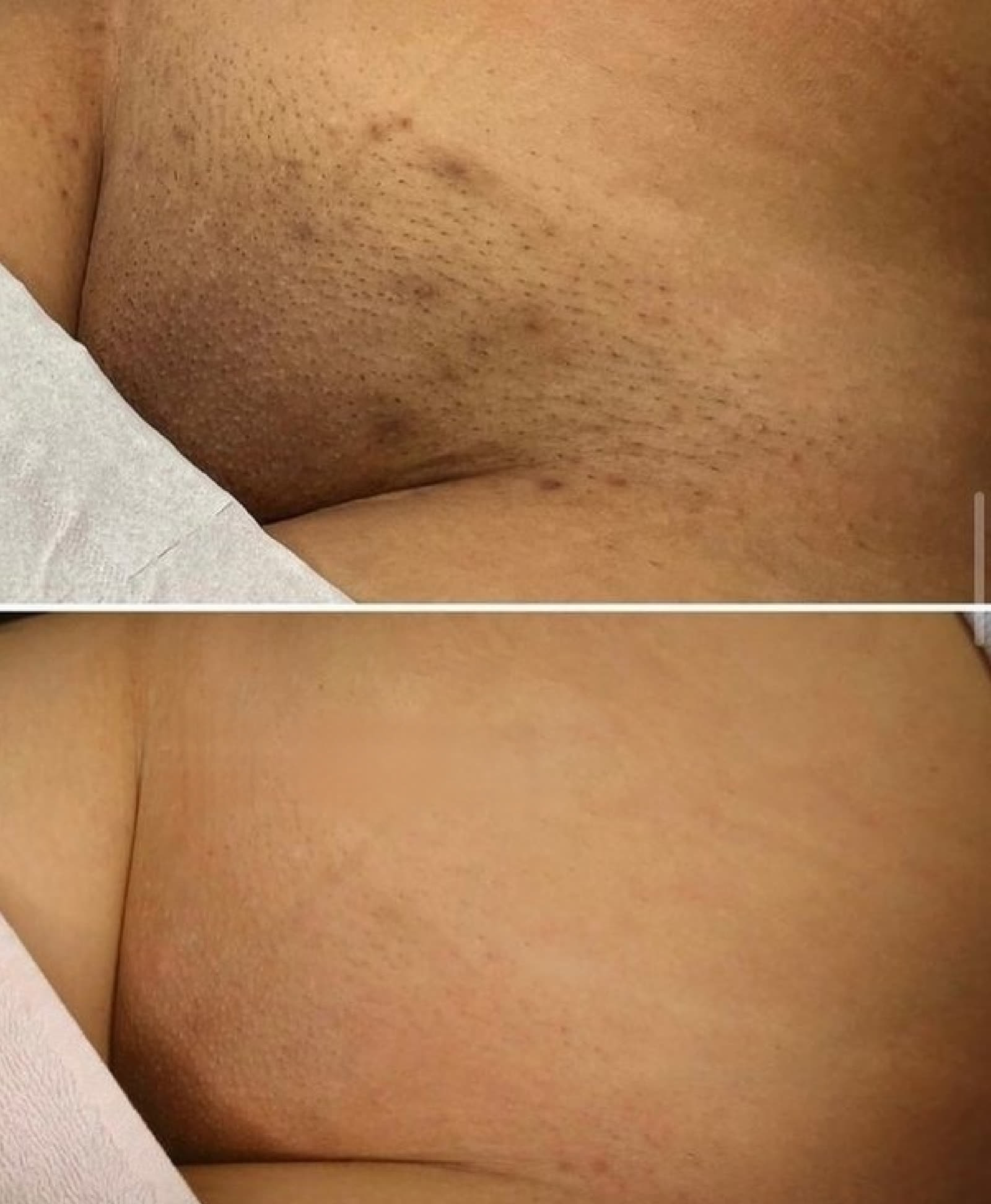 Antes y después de depilación láser en abdomen bajo